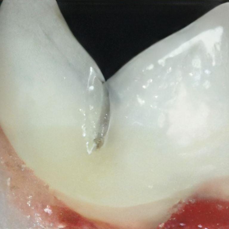 feline periodontal disease with tartar build up.
