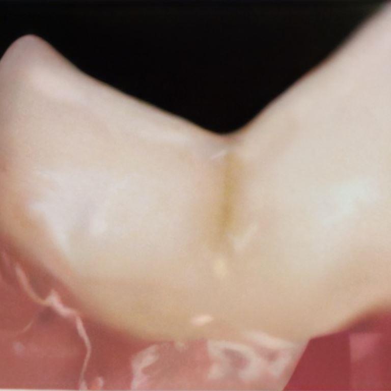 feline periodontal disease with advanced gum disease.